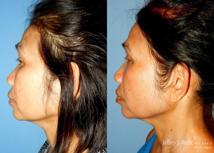 Before & After Eyelid Surgery Case 137 View #3 View in Las Vegas and Henderson, NV