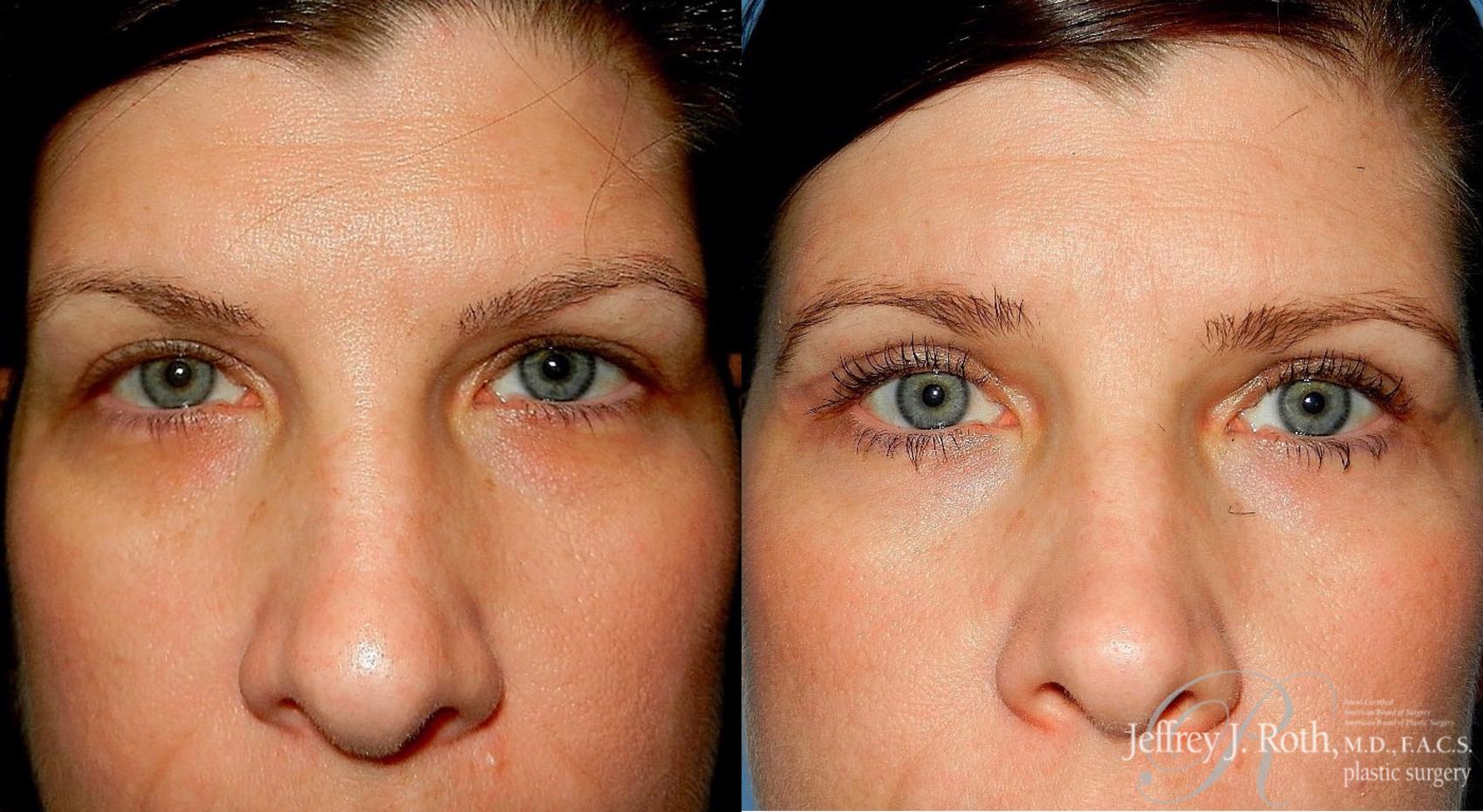 Before & After Eyelid Surgery Case 138 View #2 View in Las Vegas, NV