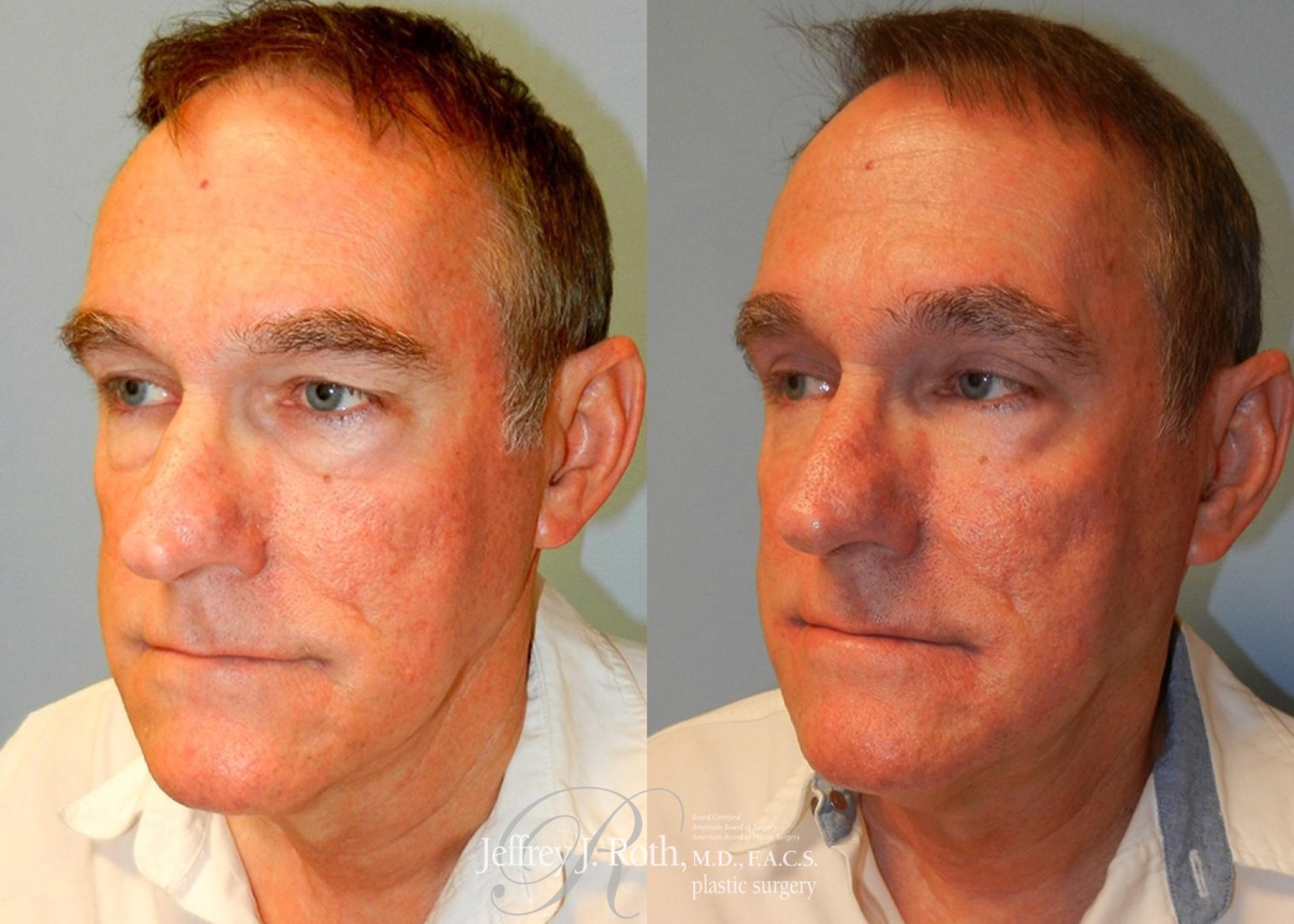 Before & After Eyelid Surgery Case 169 View #1 View in Las Vegas, NV
