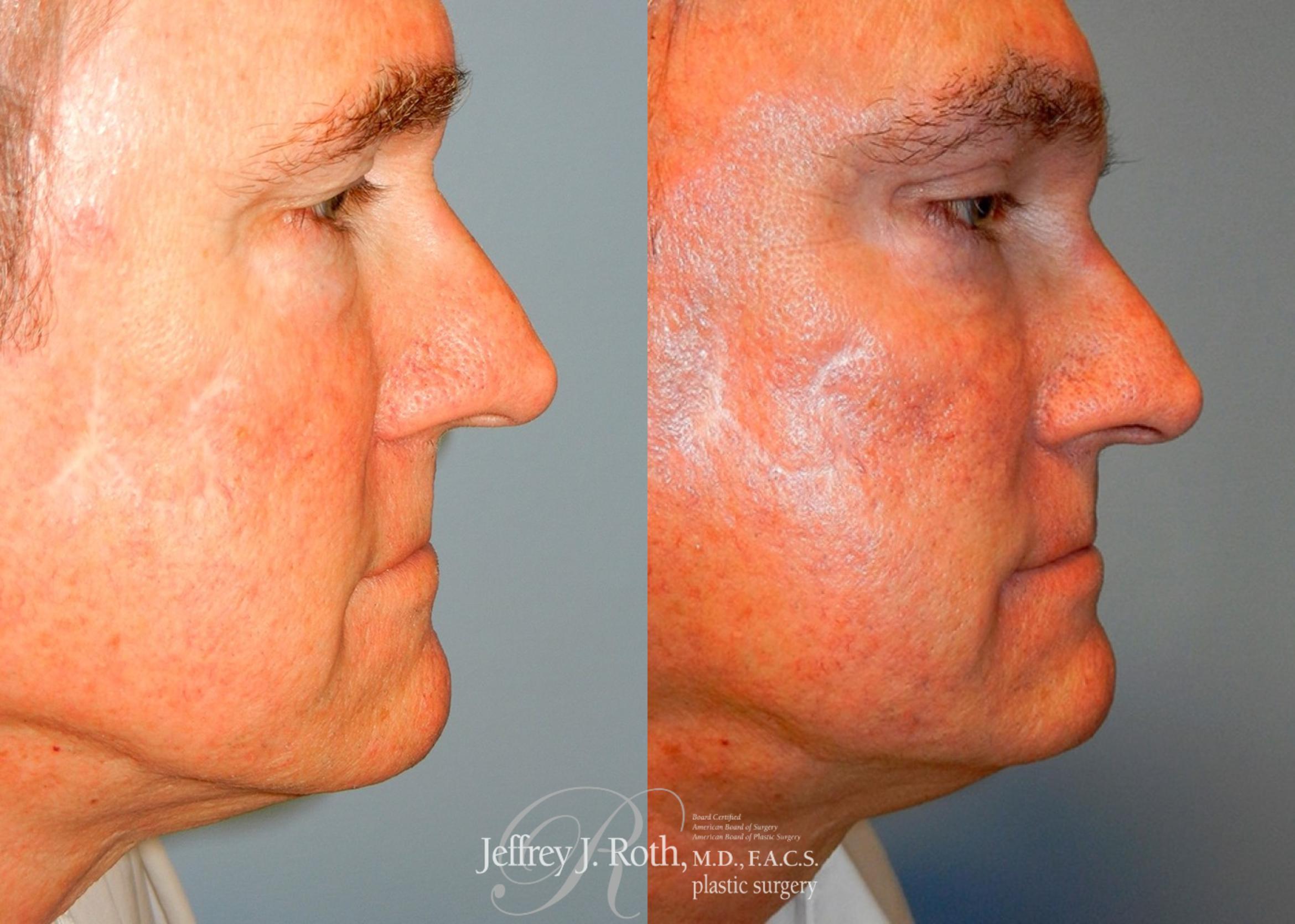 Before & After Eyelid Surgery for Men Case 169 View #2 View in Las Vegas, NV