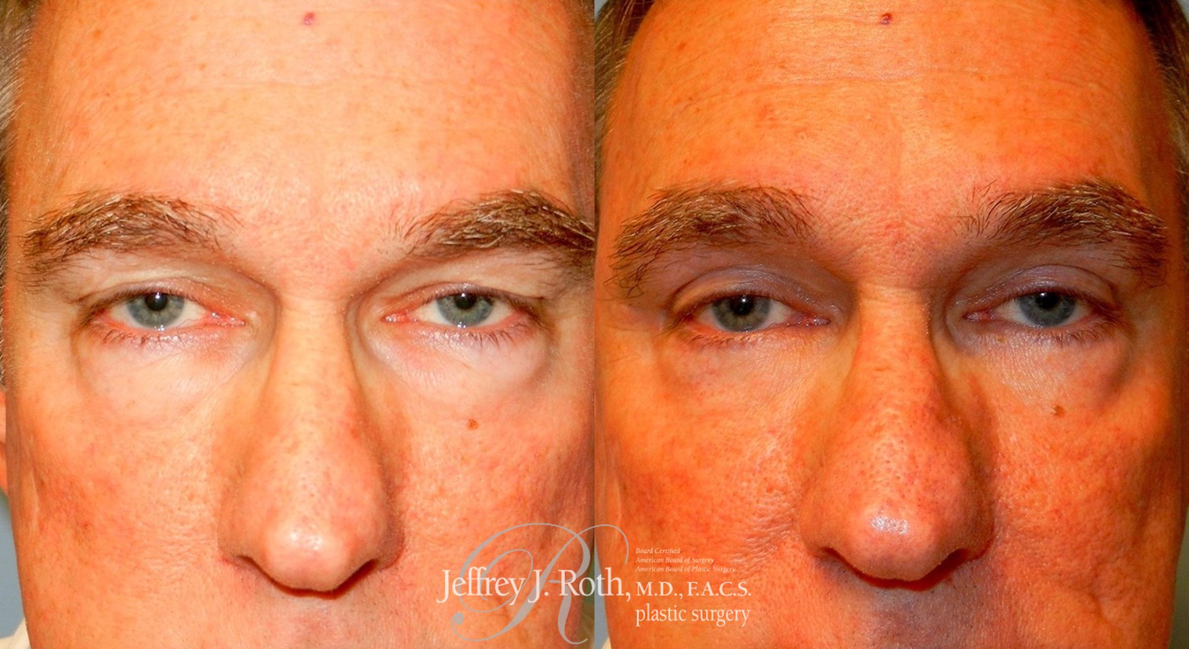 Before & After Eyelid Surgery Case 169 View #3 View in Las Vegas, NV