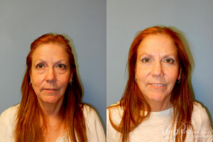 Before & After Eyelid Surgery Case 224 Front (Other) View in Las Vegas and Henderson, NV