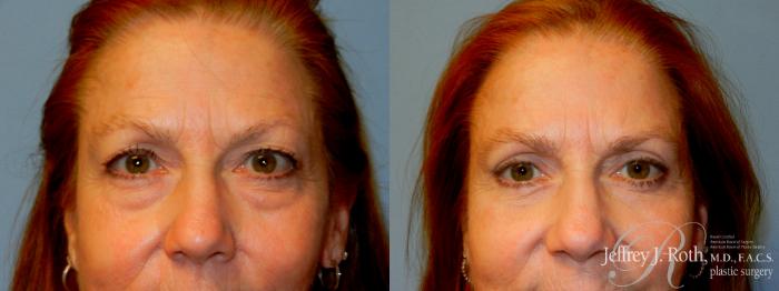 Before & After Eyelid Surgery Case 224 Front View in Las Vegas, NV