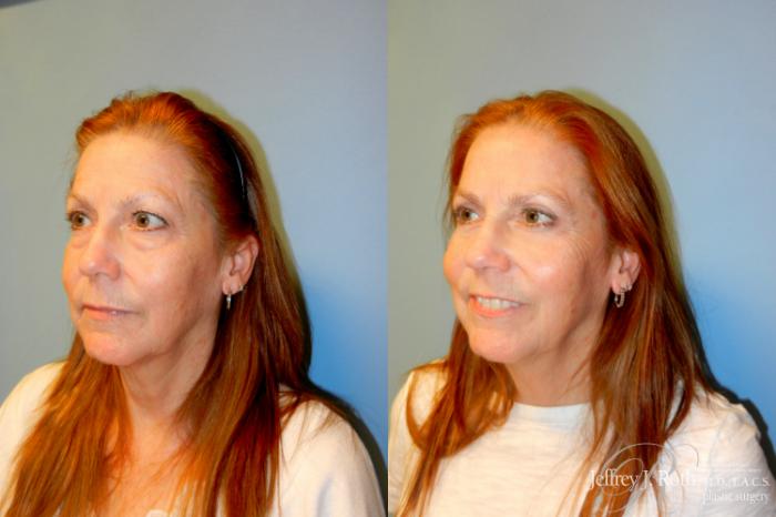 Before & After Eyelid Surgery Case 224 Left Oblique View in Las Vegas and Henderson, NV