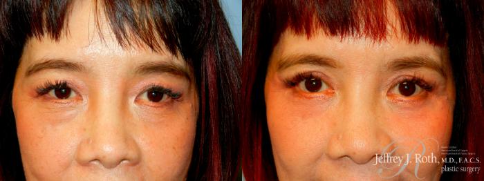 Before & After Eyelid Surgery Case 230 Front View in Las Vegas, NV