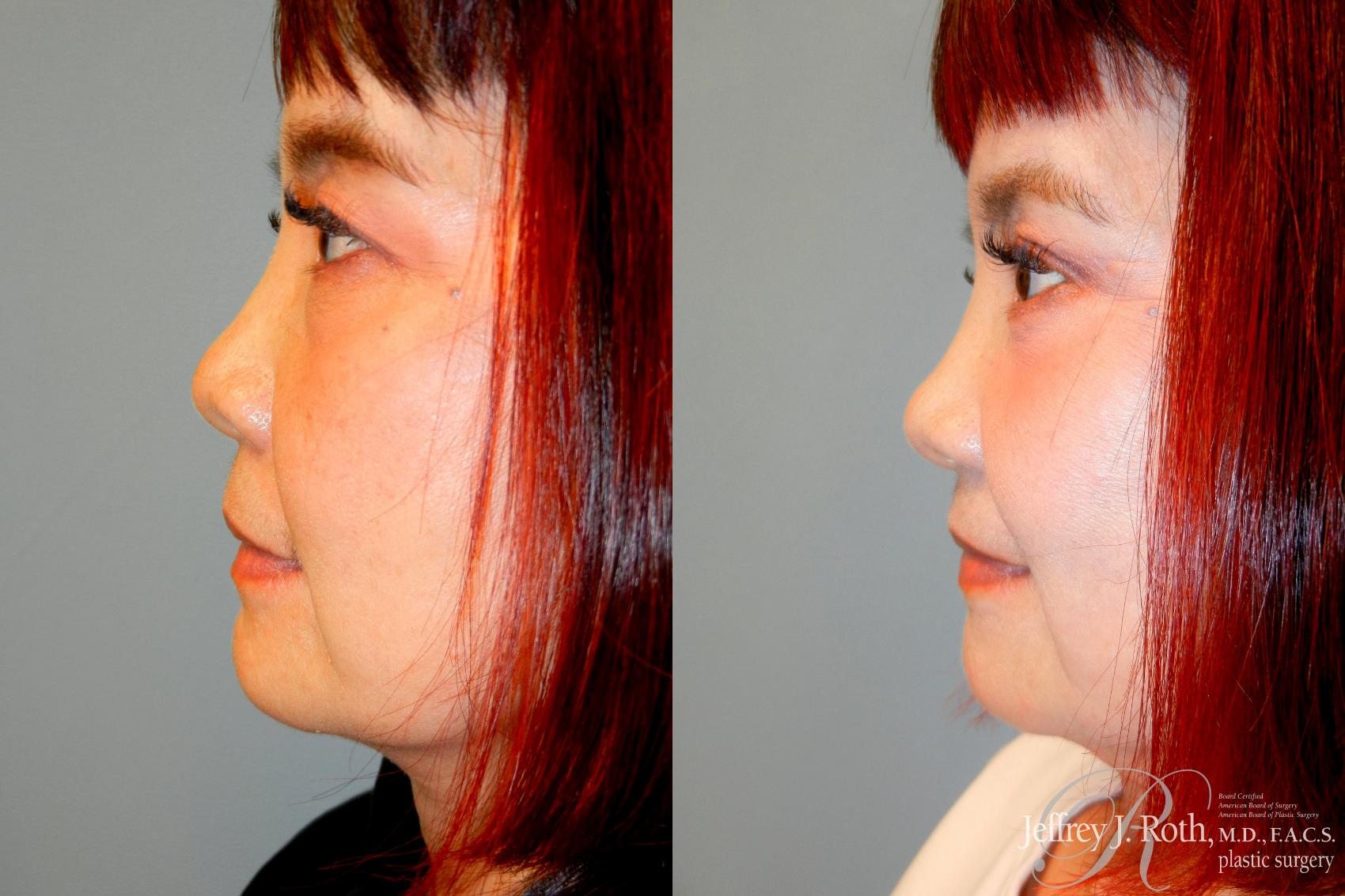 Before & After Eyelid Surgery Case 230 Left Side View in Las Vegas, NV