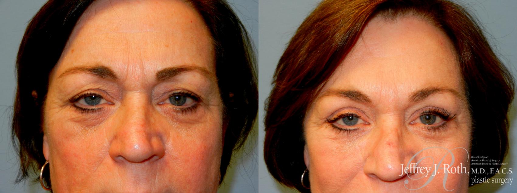 Before & After Eyelid Surgery Case 237 Front View in Las Vegas and Henderson, NV