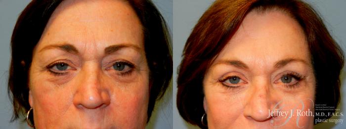 Before & After Eyelid Surgery Case 237 Front View in Las Vegas, NV