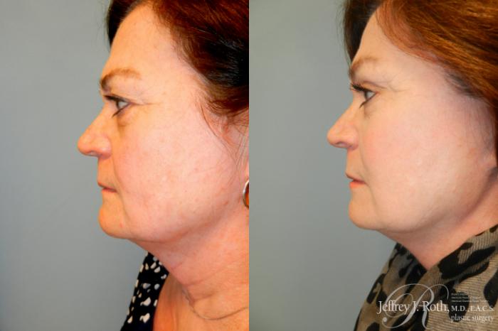 Before & After Eyelid Surgery Case 237 Left Side View in Las Vegas and Henderson, NV