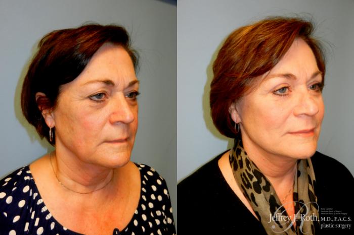 Before & After Eyelid Surgery Case 237 Right Oblique View in Las Vegas and Henderson, NV