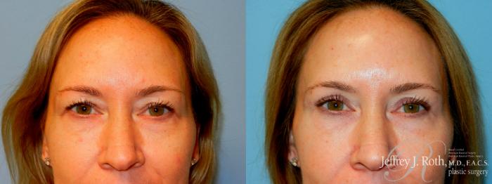 Before & After Eyelid Surgery Case 248 Front View in Las Vegas, NV