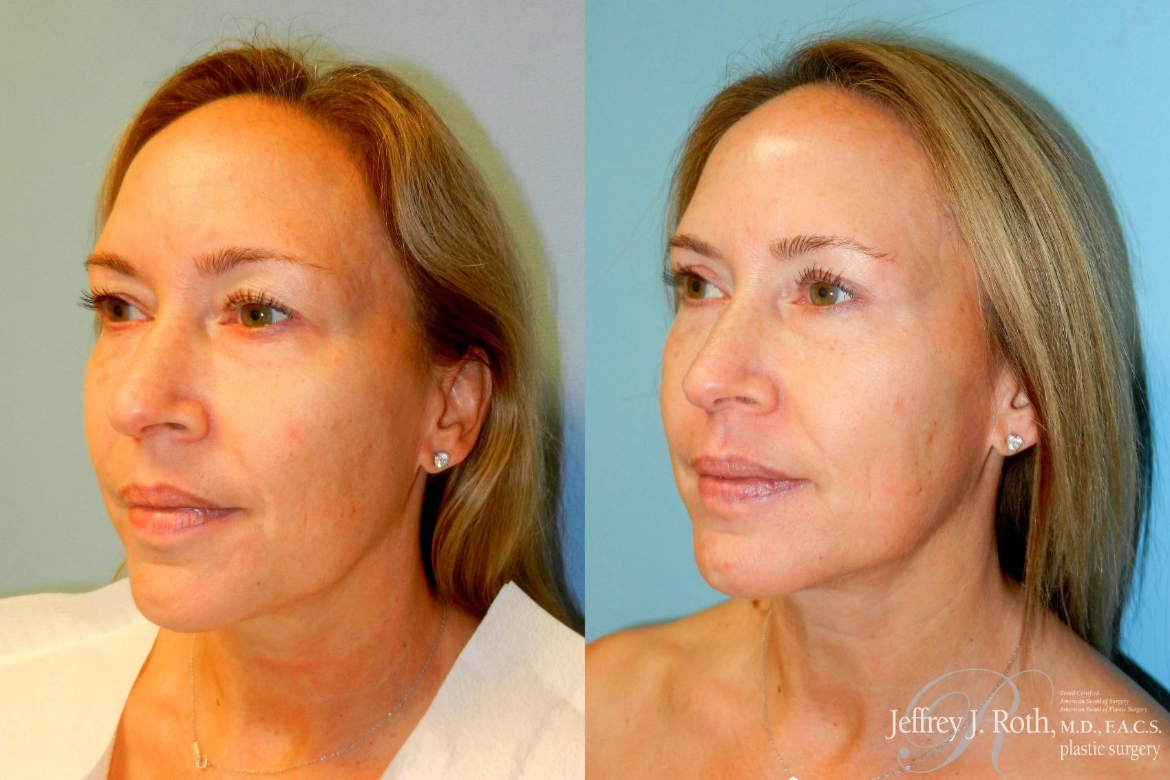 Eyelid Surgery Before and After Pictures Case 248 | Las Vegas and