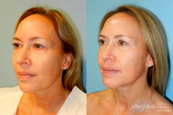 Before & After Eyelid Surgery Case 248 Left Oblique View in Las Vegas and Henderson, NV