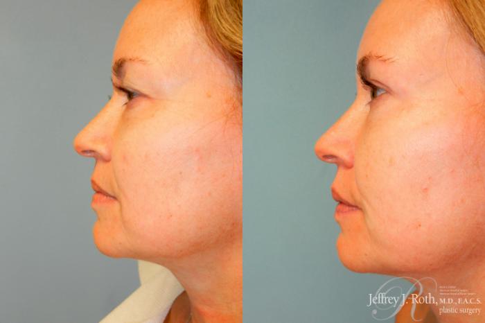 Before & After Eyelid Surgery Case 248 Left Side View in Las Vegas and Henderson, NV