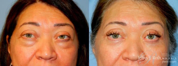 Before & After Eyelid Surgery Case 277 Front Close View in Las Vegas and Henderson, NV