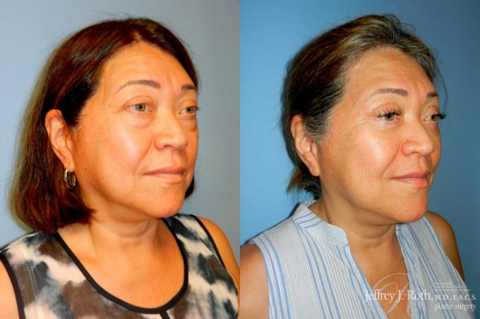 Before & After Eyelid Surgery Case 277 Right Oblique View in Las Vegas and Henderson, NV