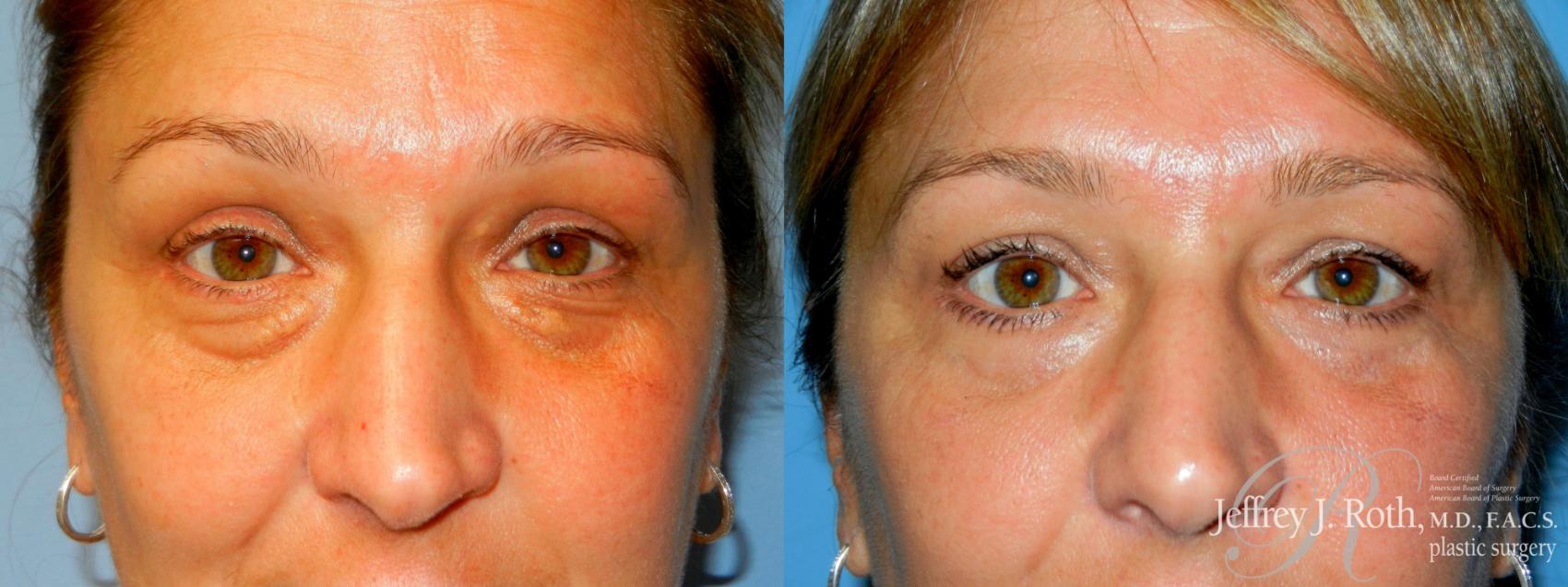 Before & After Eyelid Surgery Case 278 Front View in Las Vegas and Henderson, NV