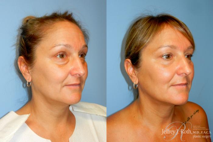 Before & After Eyelid Surgery Case 278 Right Oblique View in Las Vegas and Henderson, NV
