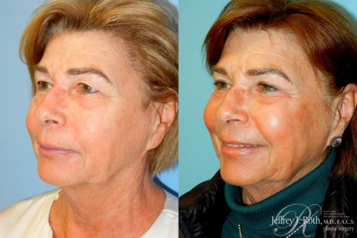 Before & After Eyelid Surgery Case 312 Left Oblique View in Las Vegas and Henderson, NV