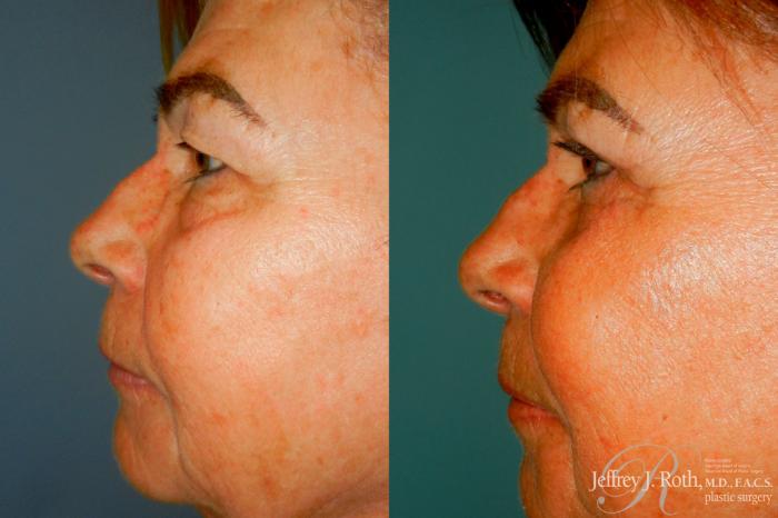 Before & After Eyelid Surgery Case 312 Left Side View in Las Vegas and Henderson, NV