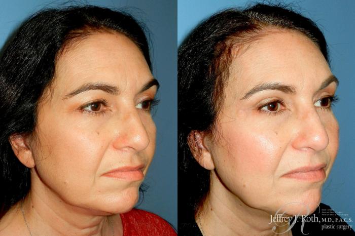 Before & After Eyelid Surgery Case 316 Right Oblique View in Las Vegas and Henderson, NV