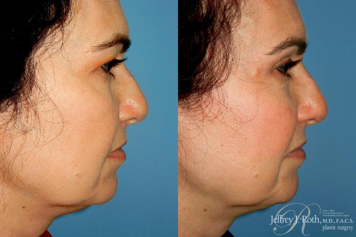 Before & After Eyelid Surgery Case 316 Right Side View in Las Vegas and Henderson, NV