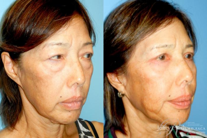 Before & After Eyelid Surgery Case 334 Right Oblique View in Las Vegas and Henderson, NV