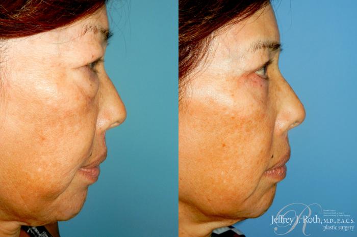 Before & After Eyelid Surgery Case 334 Right Side View in Las Vegas and Henderson, NV