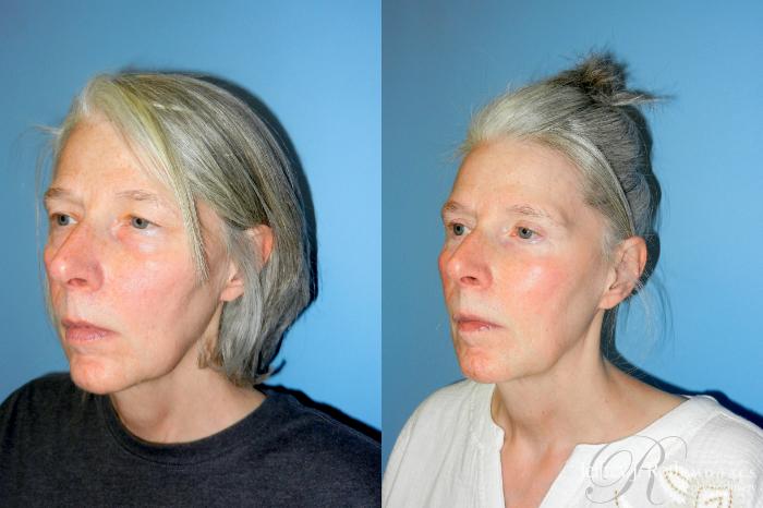 Before & After Eyelid Surgery Case 338 Left Oblique View in Las Vegas and Henderson, NV