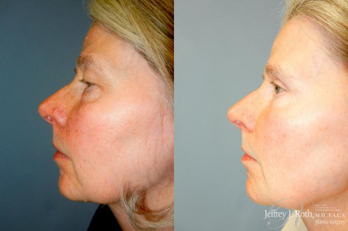 Before & After Eyelid Surgery Case 338 Left Side View in Las Vegas and Henderson, NV