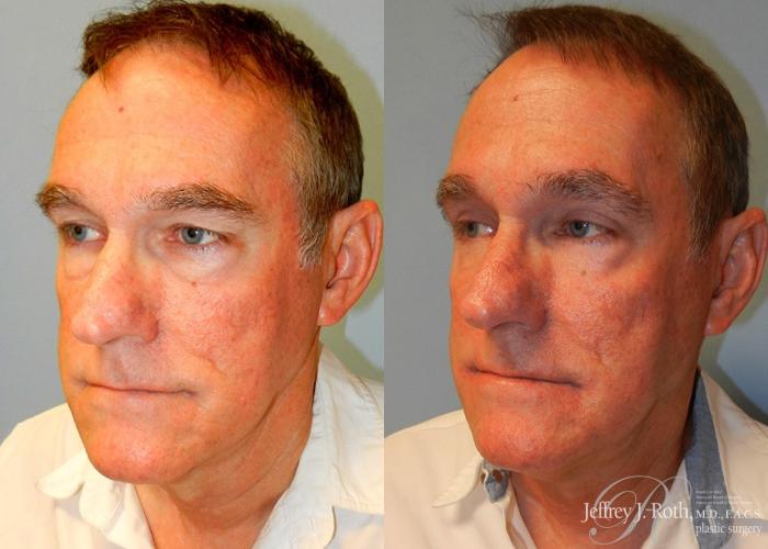 Before & After Eyelid Surgery Case 169 View #1 View in Las Vegas and Henderson, NV