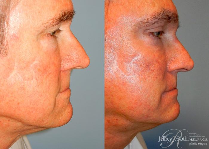 Before & After Eyelid Surgery for Men Case 169 View #2 View in Las Vegas and Henderson, NV