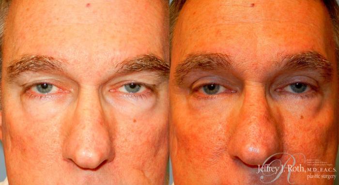 Before & After Eyelid Surgery for Men Case 169 View #3 View in Las Vegas and Henderson, NV