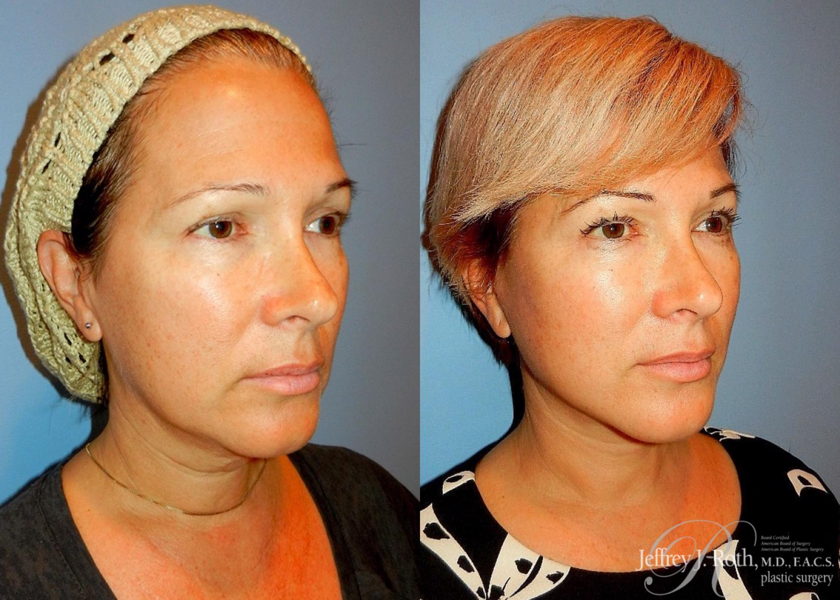 Before & After Facelift & Neck Lift Case 139 View #2 View in Las Vegas, NV