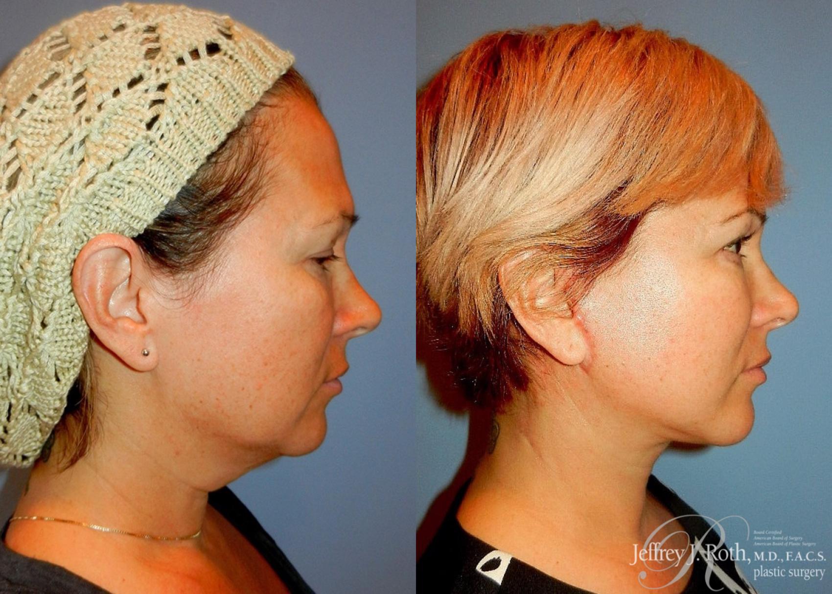 Before & After Facelift & Neck Lift Case 139 View #3 View in Las Vegas, NV