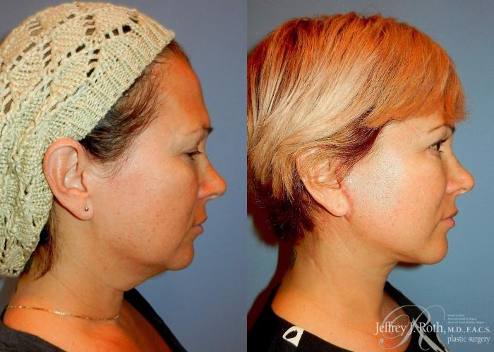 Before & After Facelift & Neck Lift Case 139 View #3 View in Las Vegas, NV