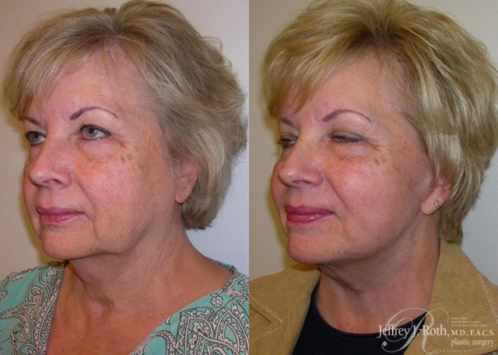 Before & After Facelift & Neck Lift Case 140 View #2 View in Las Vegas, NV
