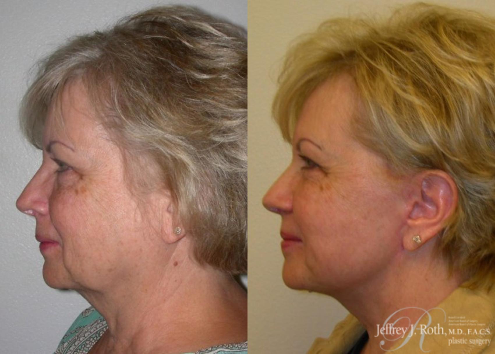 Before & After Facelift & Neck Lift Case 140 View #3 View in Las Vegas, NV