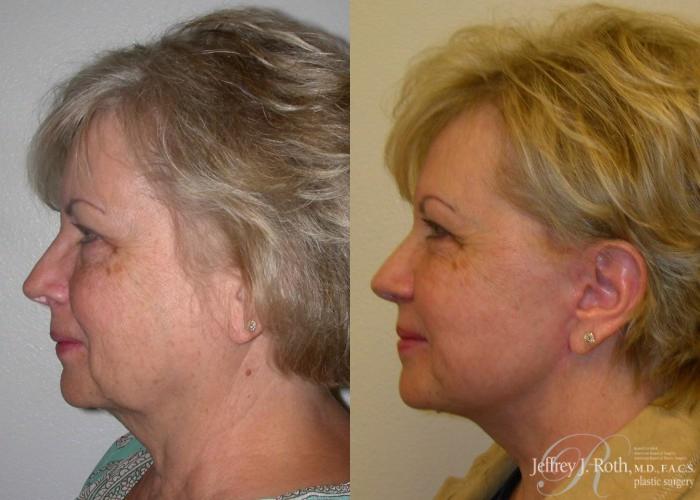 Before & After Facelift & Neck Lift Case 140 View #3 View in Las Vegas and Henderson, NV