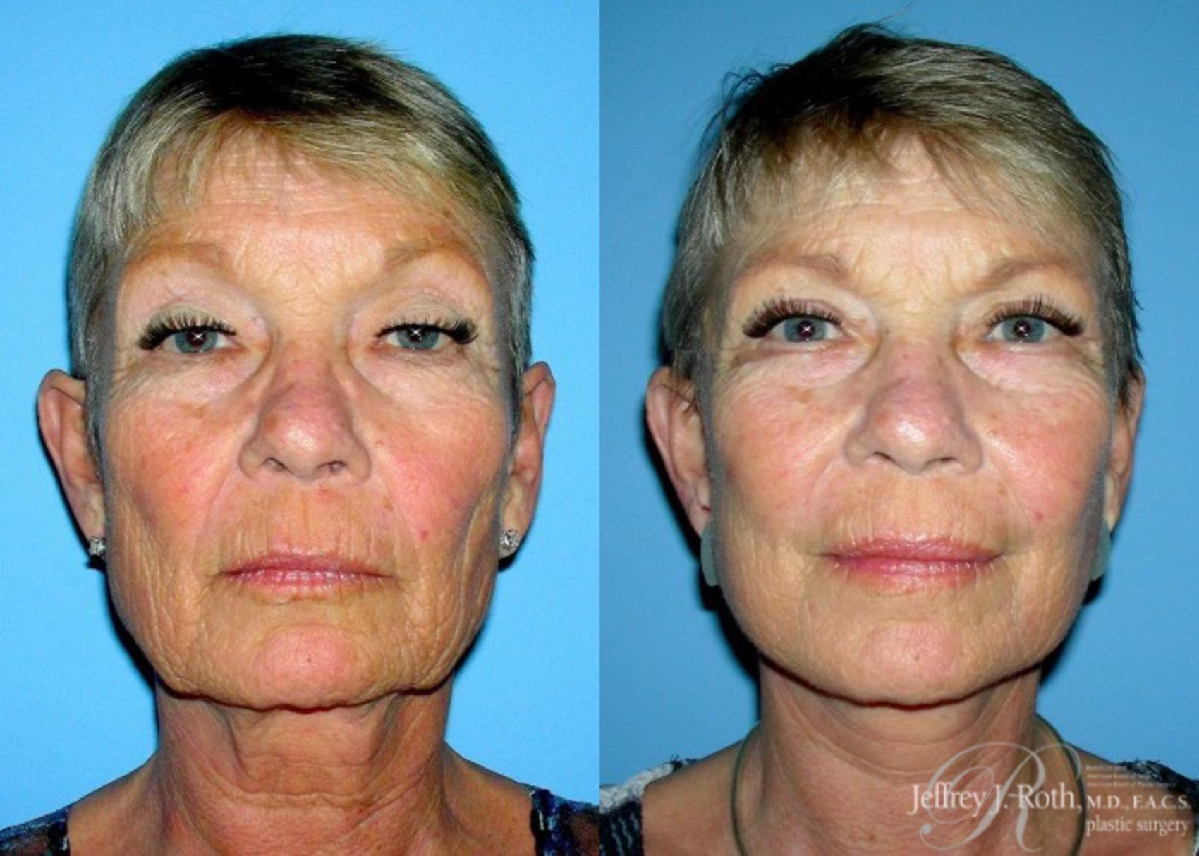 Before & After Facelift & Neck Lift Case 141 View #1 View in Las Vegas, NV