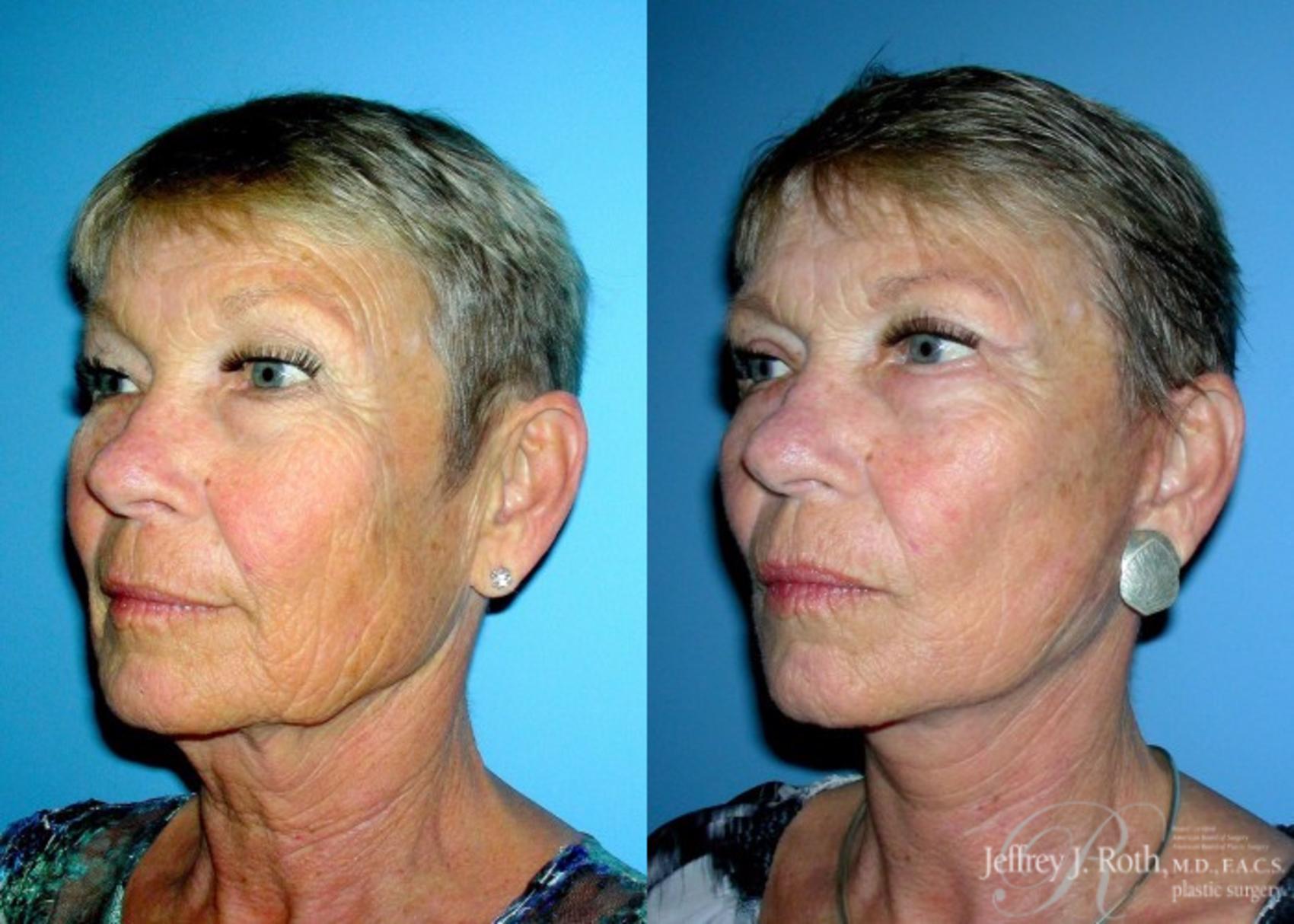 Before & After Facelift & Neck Lift Case 141 View #2 View in Las Vegas, NV