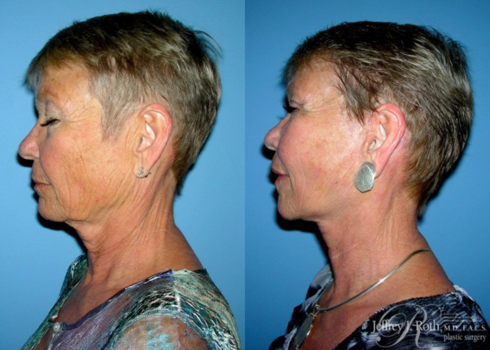Before & After Facelift & Neck Lift Case 141 View #3 View in Las Vegas, NV