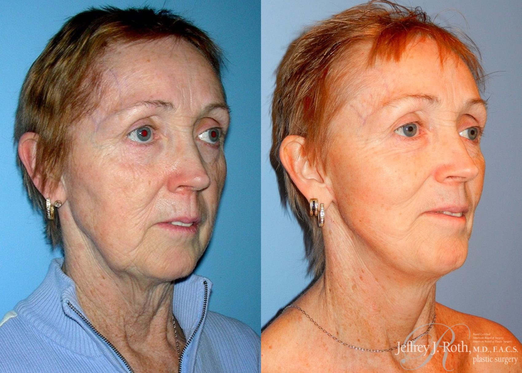 Before & After Facelift & Neck Lift Case 142 View #2 View in Las Vegas, NV