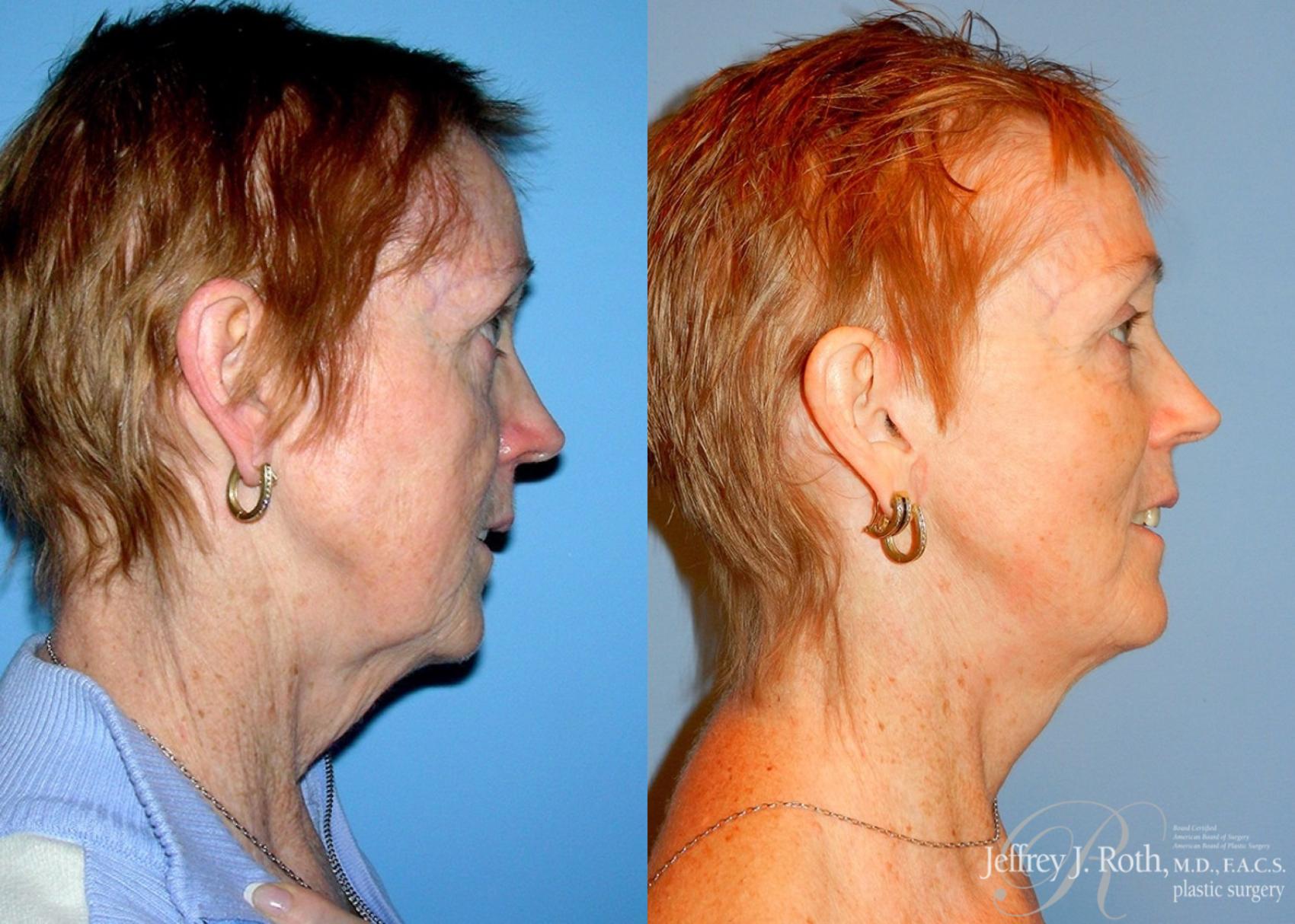 Before & After Facelift & Neck Lift Case 142 View #3 View in Las Vegas, NV