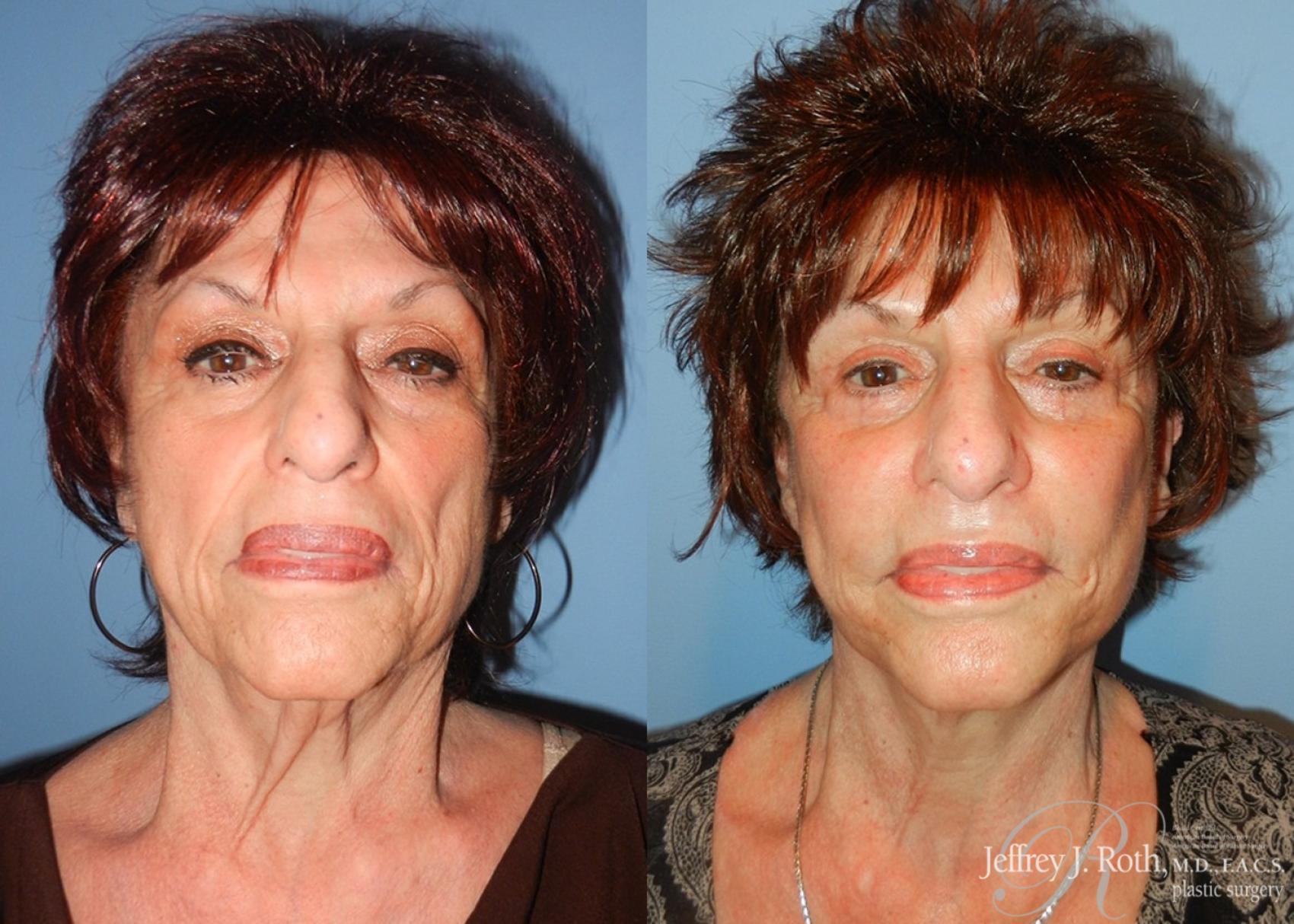 Before & After Facelift & Neck Lift Case 143 View #1 View in Las Vegas, NV