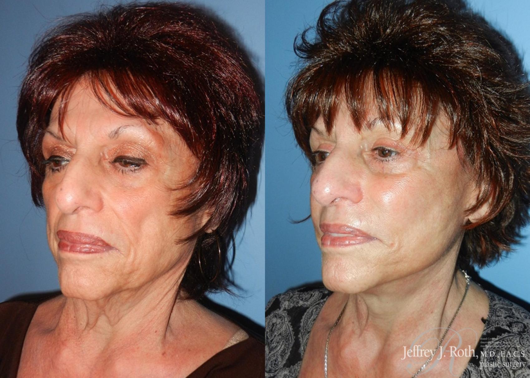Before & After Facelift & Neck Lift Case 143 View #2 View in Las Vegas, NV