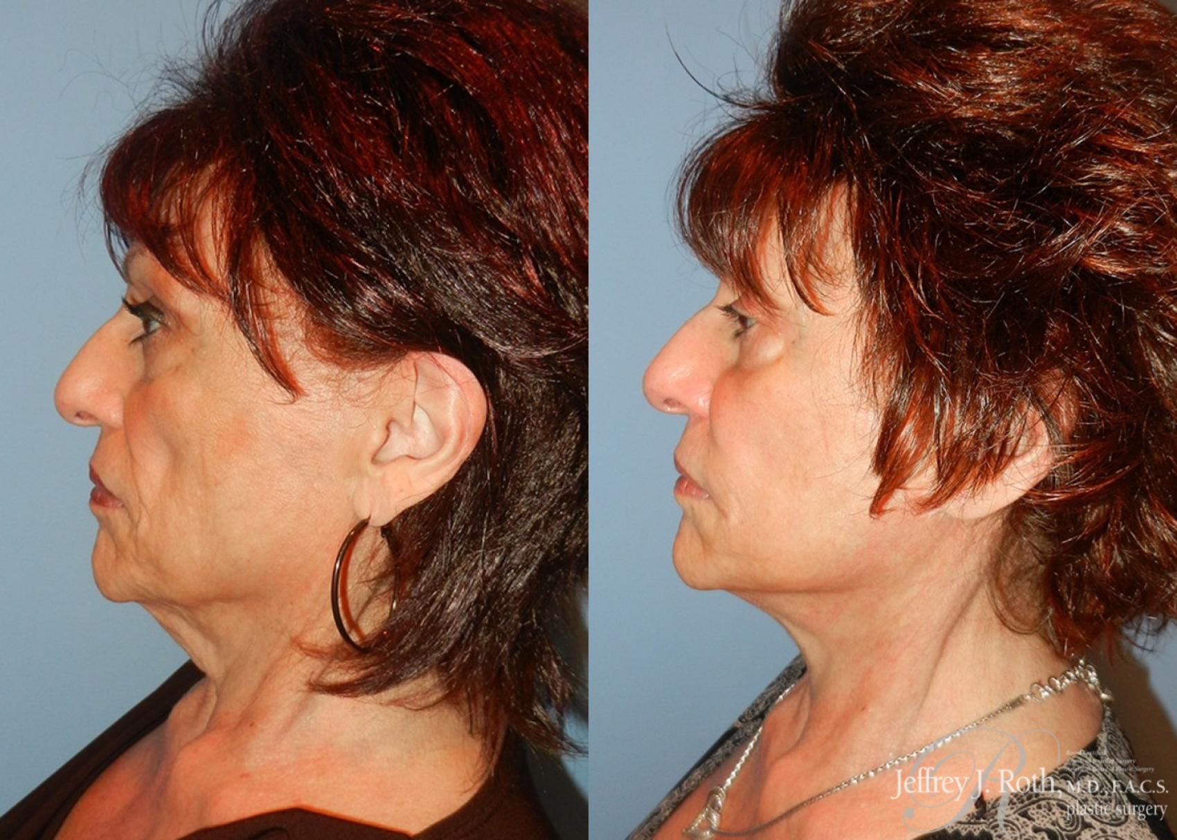 Before & After Facelift & Neck Lift Case 143 View #3 View in Las Vegas, NV