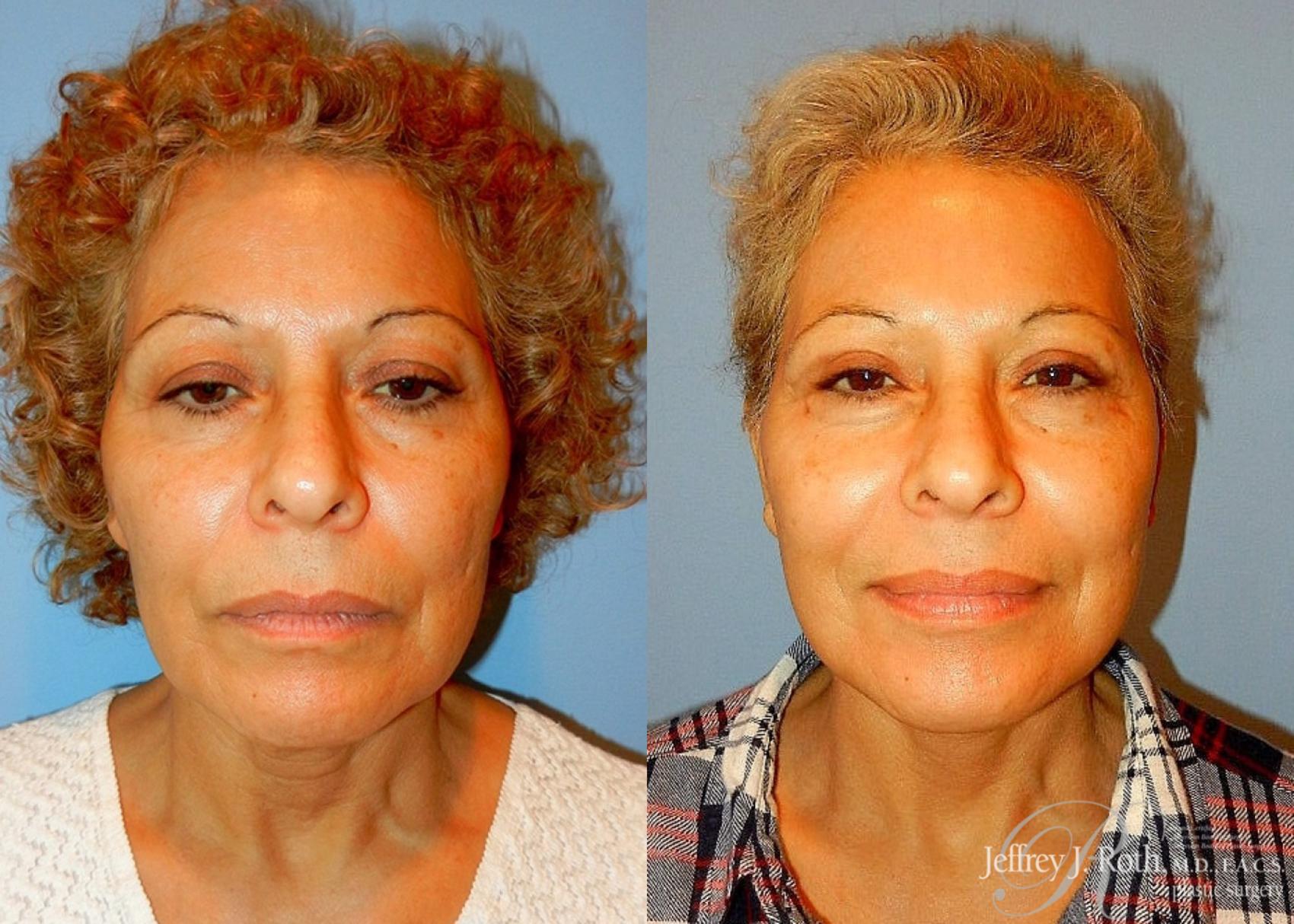 Before & After Facelift & Neck Lift Case 144 View #1 View in Las Vegas, NV
