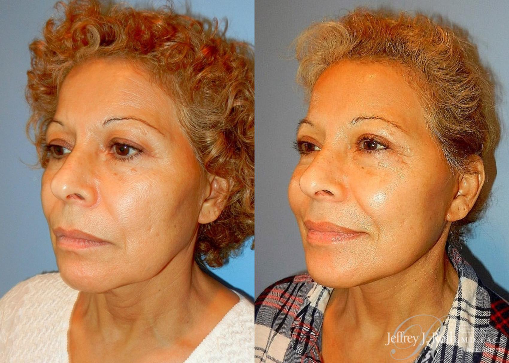 Before & After Facelift & Neck Lift Case 144 View #2 View in Las Vegas, NV
