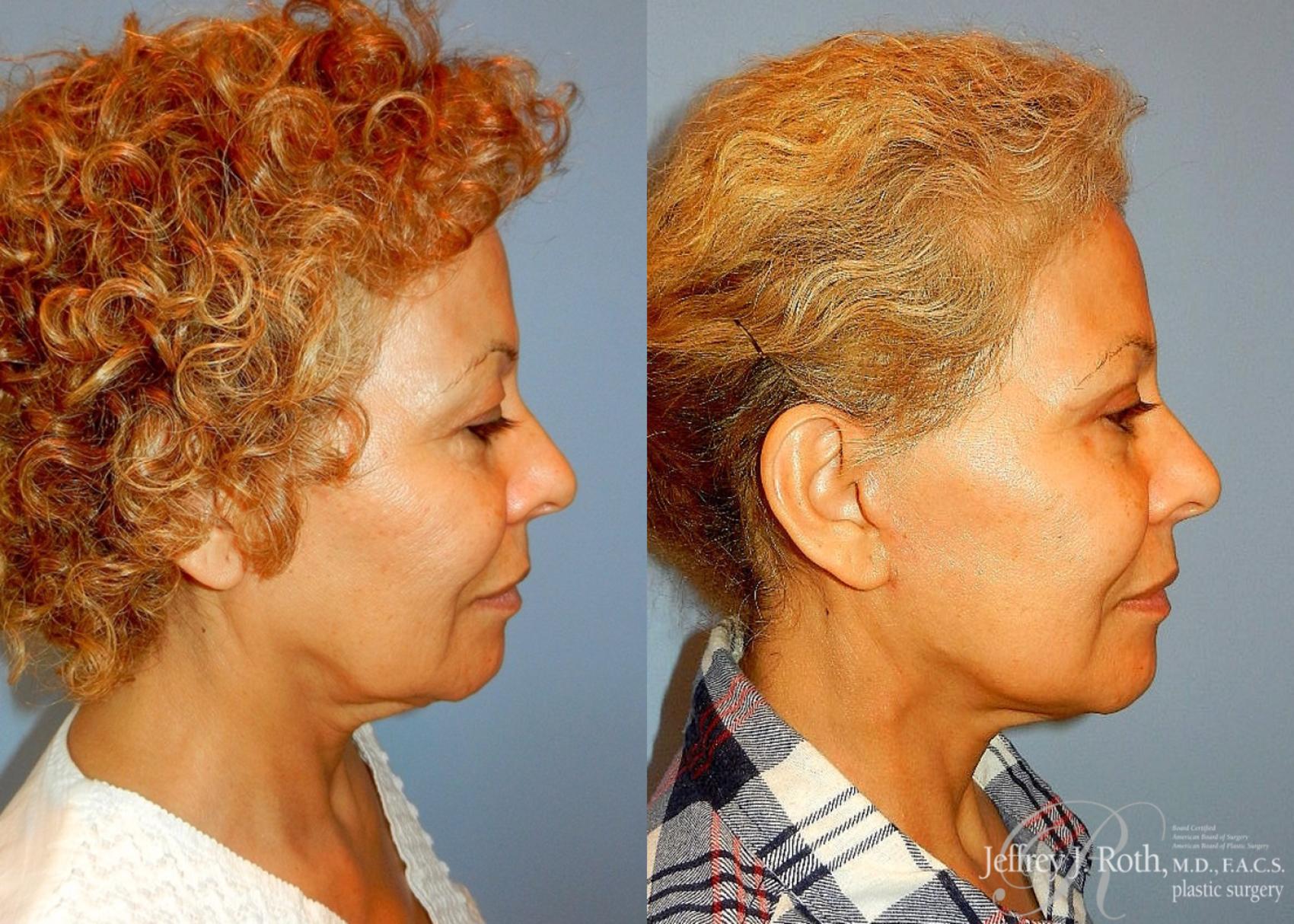 Before & After Facelift & Neck Lift Case 144 View #3 View in Las Vegas, NV
